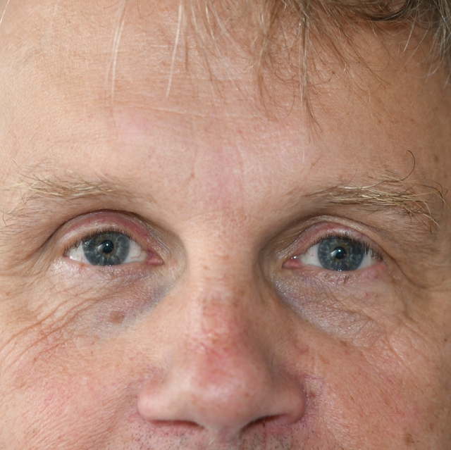 Endoskopiskt pannlyft