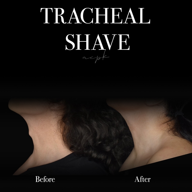 Ansiktsfeminiserande kirurgi med reducering av adamsäpplet (Tracheal Shave) –Före- och efter bilder- Dr Matteo Amoroso -Stockholm