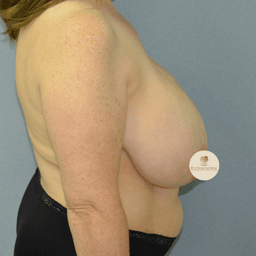 Bröstförminskning + bröstlyft med interverad T-incision och med ankarlyft teknik