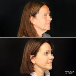 Ansiktslyft med fettsugning av hals samt fettransplantation - före och efter