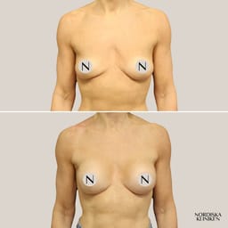 Bröstutfyllnad med Mia Femtech - före och efter Bröstutfyllnad med Mia Femtech - före och efter