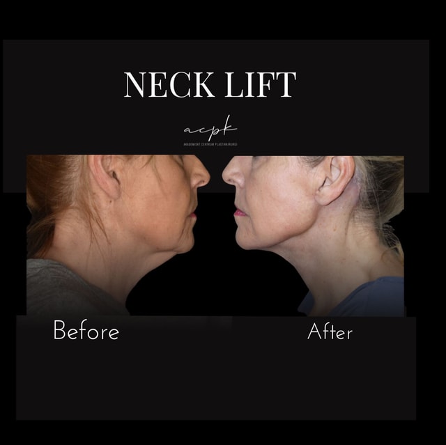 Deep Plane Halslyft / Neck lift - Naturligt resultat med definierad hals och käkkontur.  Plastikkirurg: Dr Matteo Amoroso.   Plats: Stockholm