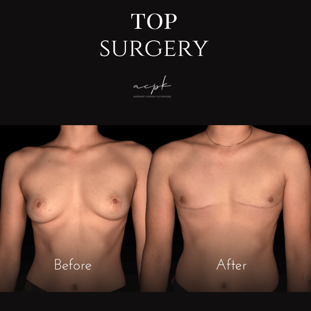 Transgender top surgery / Dubbelincisionsmastektomi med transplantation av bröstvårtor (FTM top surgery) – maskulinisering av bröstkorgen-  Före och Efter.  Dr.Matteo Amoroso Plats: Stockholm
