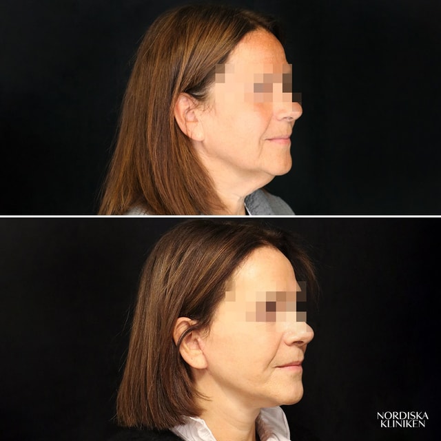 Ansiktslyft med fettsugning av hals samt fettransplantation - före och efter