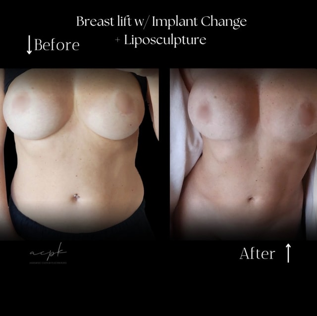 Bröstlyft med implantatbyte och liposkulptur –harmoniskt och naturligt resultat- Före och Efter . Dr.Matteo Amoroso Plats: Stockholm