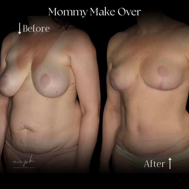 Mommy makeover – bukplastik och bröstlyft för återställd kroppskontur efter graviditet- Före och Efter- Dr.Matteo Amoroso-Stockholm