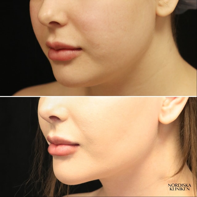Buccal fat removal och fettsugning av hals - före och efter