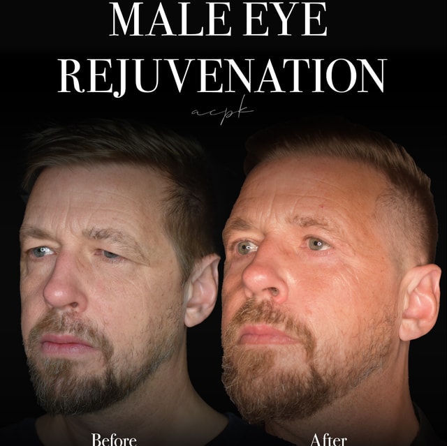 Male Eye Rejuvenation - Övre och Nedre ögonlockplastik (blefaroplastik) - Före och Efter - Plastikkirurg: Dr Matteo Amoroso. Plats: Stockholm