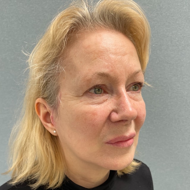 Ansiktslyft, pannlyft och liten fettransplantation