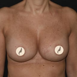 Bröstförstoring Mentor Bröstförstoring Mentor