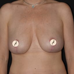 Bröstreduktion, bröstförminskning Bröstreduktion, bröstförminskning