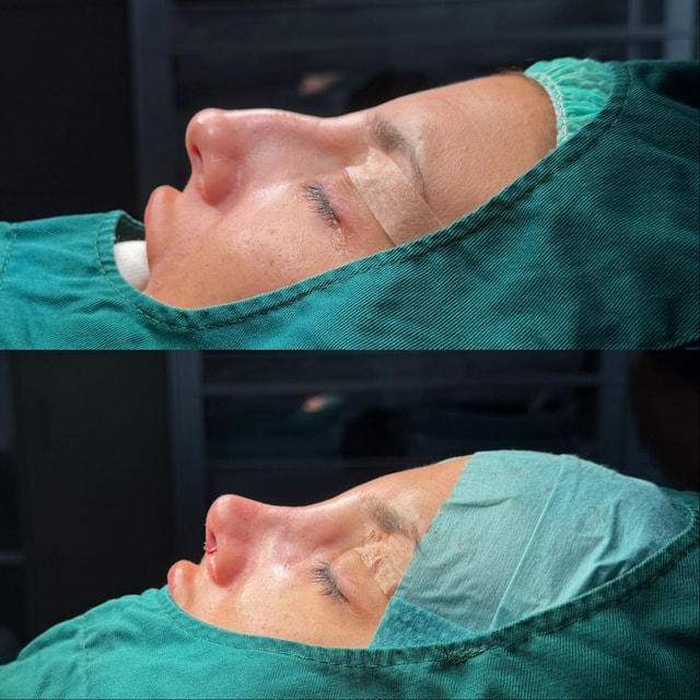 primär näsplastik/Rhinoplasty primär näsplastik/Rhinoplasty