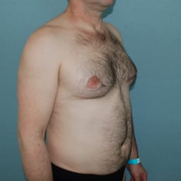 Gynekomasti + fettsugning Gynekomasti + fettsugning