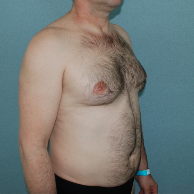 Gynekomasti + fettsugning
