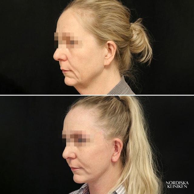 Nedre ansiktslyft med fettsugning av hals och fettransplantation – före och efter Nedre ansiktslyft med fettsugning av hals och fettransplantation – före och efter