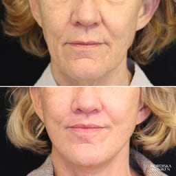 Deep plane facelift och läpplyft för en mer definierad ansiktskontur och föryngring - före och efter Deep plane facelift och läpplyft för en mer definierad ansiktskontur och föryngring - före och efter