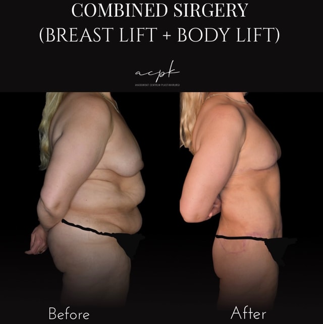 Kombinationsingrepp: Bröstlyft och Cirkulär Body Lift och Fettsugning - Före och Efter - Dr.Matteo Amoroso Plats: Stockholm Kombinationsingrepp: Bröstlyft och Cirkulär Body Lift och Fettsugning - Före och Efter - Dr.Matteo Amoroso Plats: Stockholm