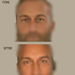 Övre och nedre blefaroplastik /ögonlocksplastik Övre och nedre blefaroplastik /ögonlocksplastik
