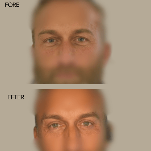 Övre och nedre blefaroplastik /ögonlocksplastik Övre och nedre blefaroplastik /ögonlocksplastik