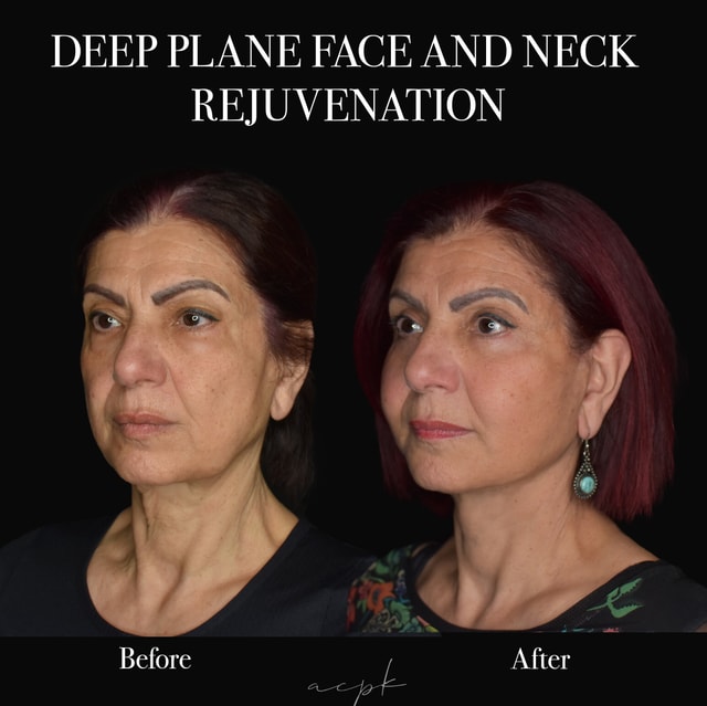 Deep Plane Facelift and Neck Lift - Före och efter - Dr.Matteo Amoroso- Stockholm Deep Plane Facelift and Neck Lift - Före och efter - Dr.Matteo Amoroso- Stockholm