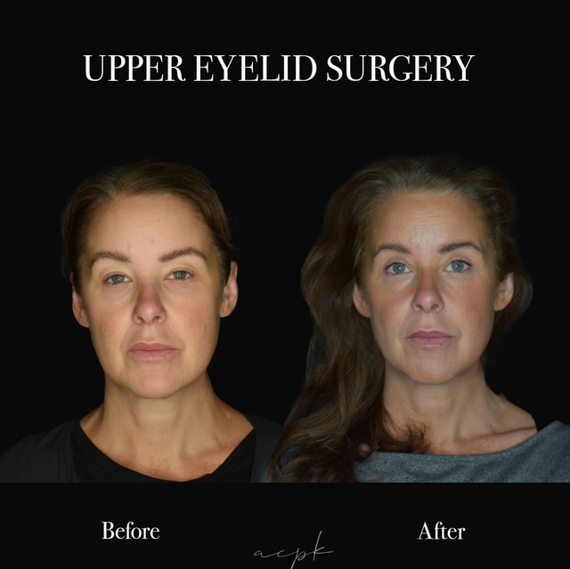 Övre ögonlocksplastik (Upper Blepharoplasty)-Före och Efter-Dr.Matteo Amoroso- Stockholm Övre ögonlocksplastik (Upper Blepharoplasty)-Före och Efter-Dr.Matteo Amoroso- Stockholm