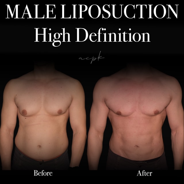 Kombinerad HD fettsugning och Gynekomastikirurgi- Före och efter- Plastikkirurg: Dr.Matteo Amoroso. Plats: Stockholm Kombinerad HD fettsugning och Gynekomastikirurgi- Före och efter- Plastikkirurg: Dr.Matteo Amoroso. Plats: Stockholm
