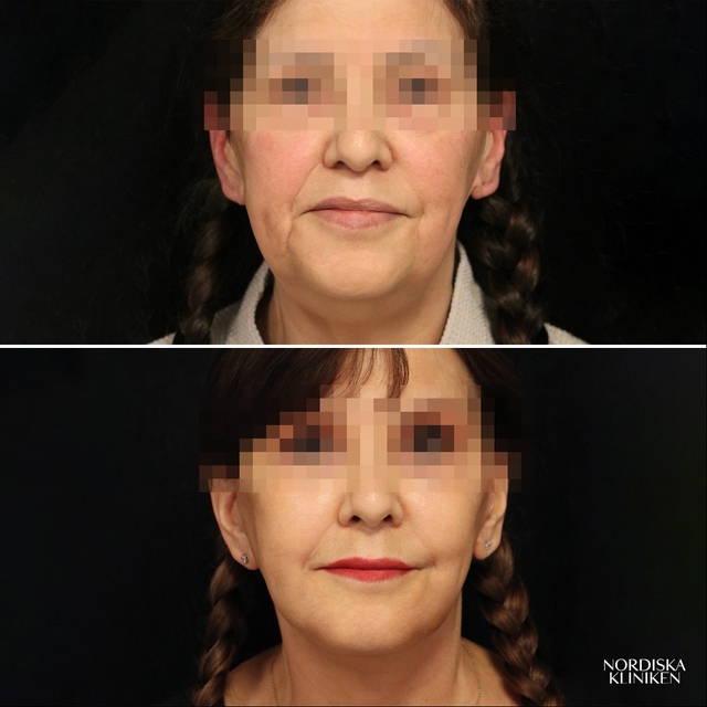 Ansiktslyft, fettransplantation och fettsugning av hals - före och efter Ansiktslyft, fettransplantation och fettsugning av hals - före och efter