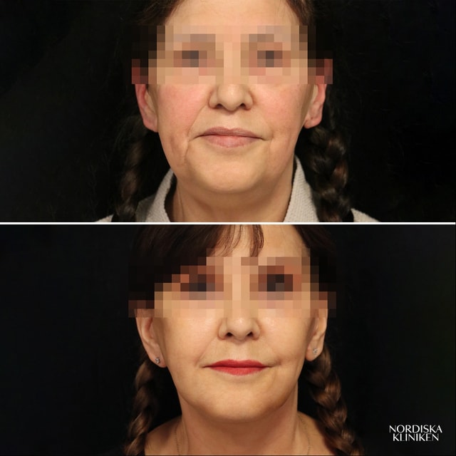 Ansiktslyft, fettransplantation och fettsugning av hals - före och efter Ansiktslyft, fettransplantation och fettsugning av hals - före och efter