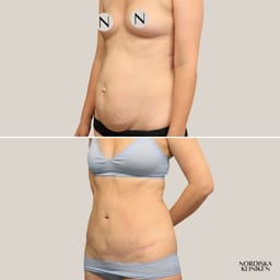 Bukplastik och fettsugning för buktande mage och diastas efter graviditet - före och efter Bukplastik och fettsugning för buktande mage och diastas efter graviditet - före och efter