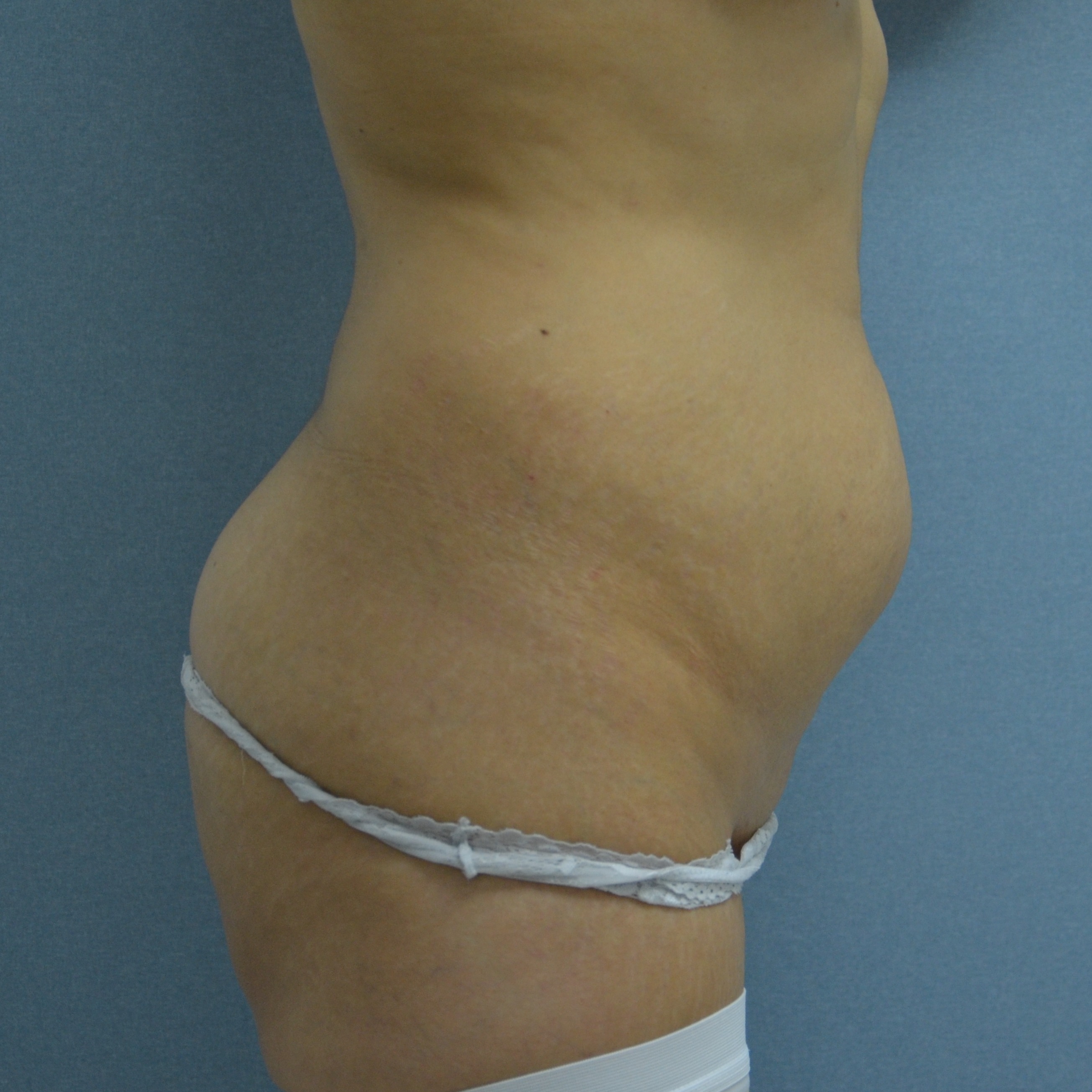 Bukplastik + fettsugning midja med Microair - 0