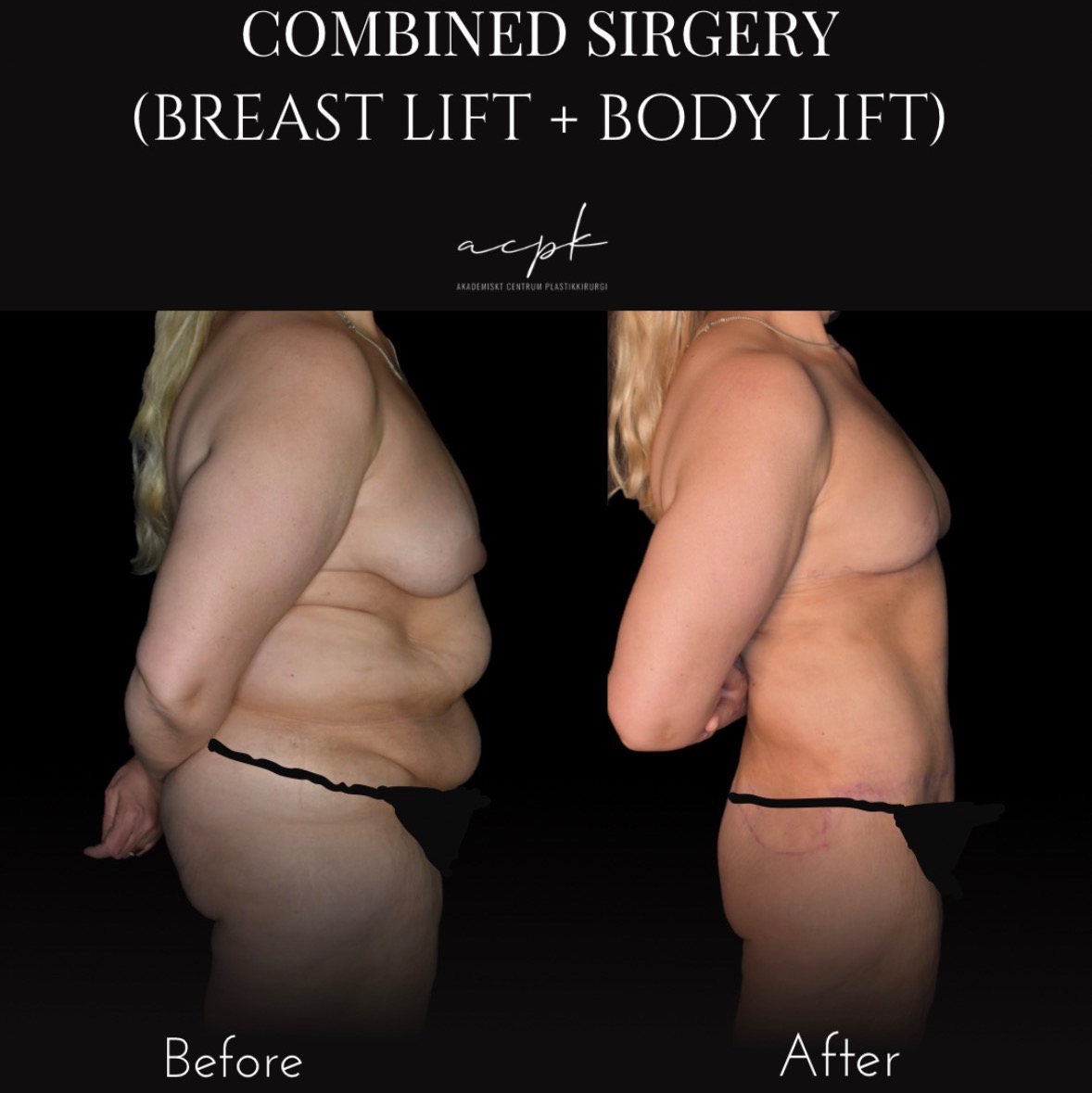 Kombinationsingrepp: Bröstlyft och Cirkulär Body Lift och Fettsugning - Före och Efter - Dr.Matteo Amoroso Plats: Stockholm - 0