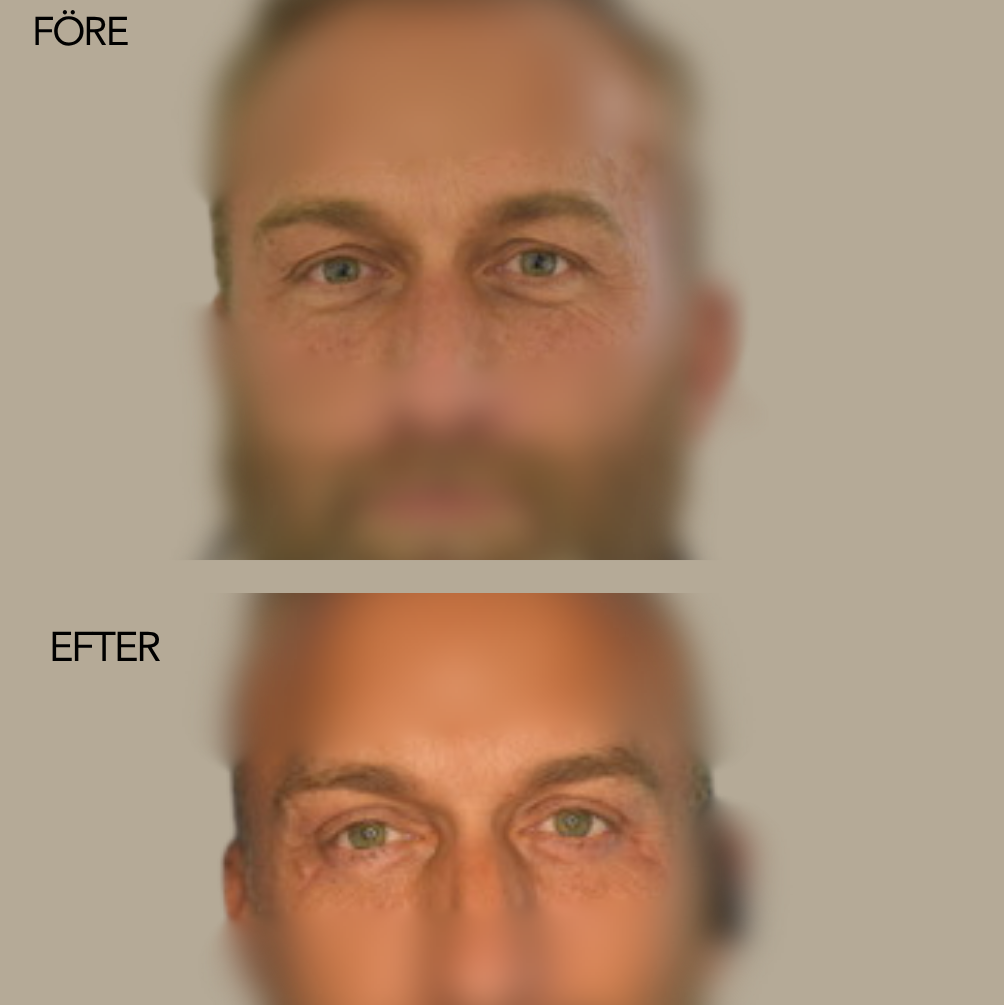 Övre och nedre blefaroplastik /ögonlocksplastik - 0