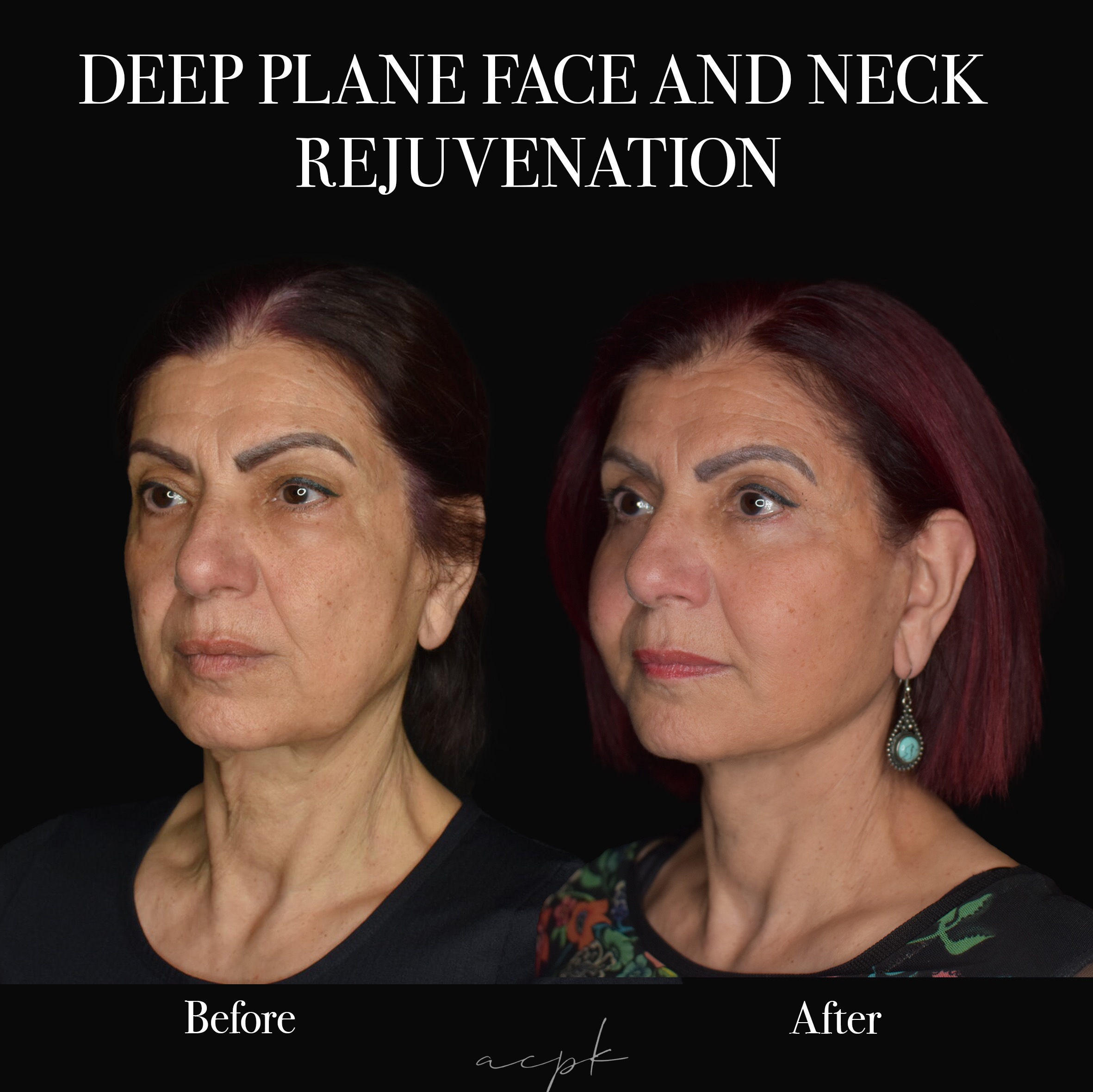 Deep Plane Facelift and Neck Lift - Före och efter - Dr.Matteo Amoroso- Stockholm - 0