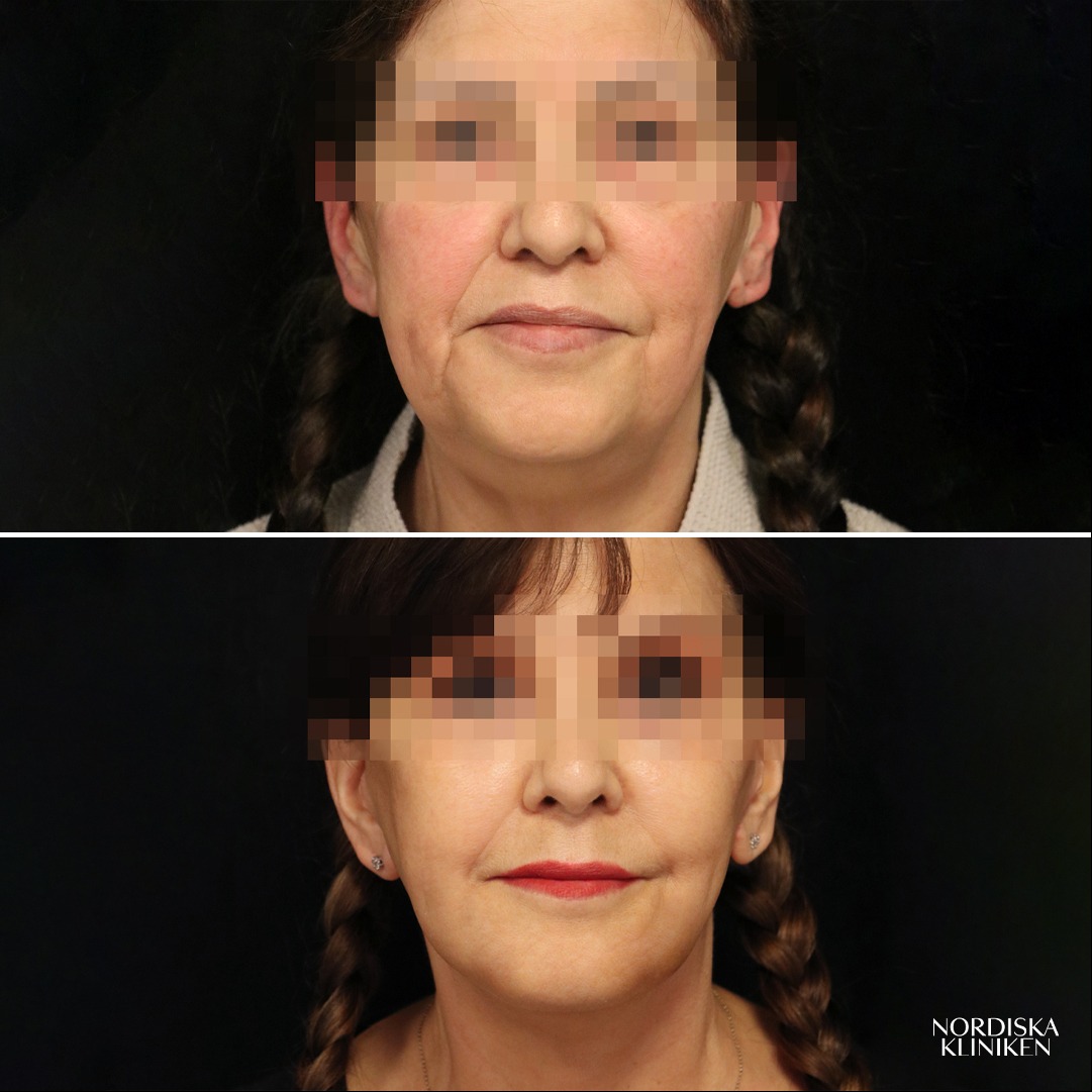Ansiktslyft, fettransplantation och fettsugning av hals - före och efter - 0